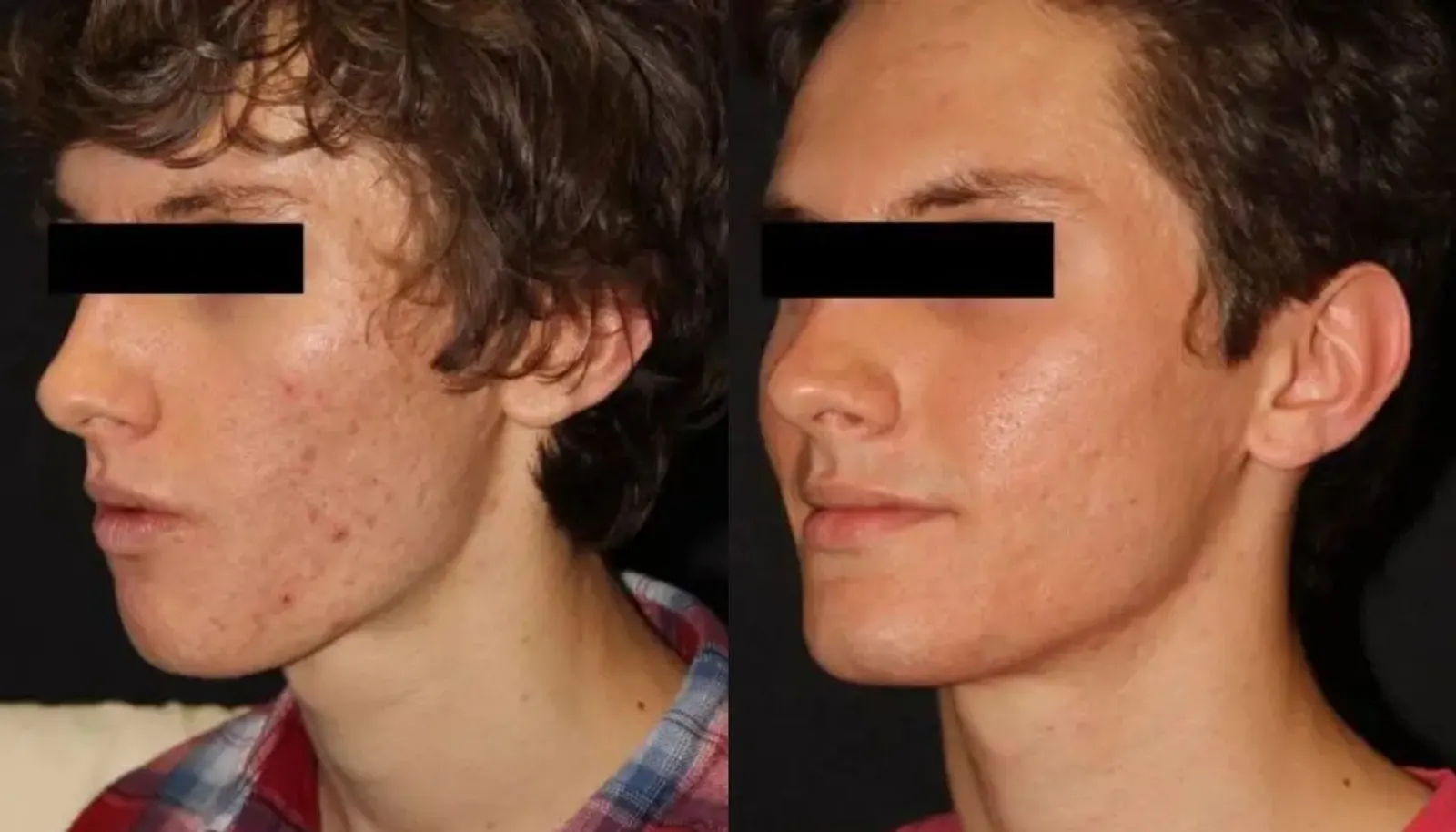 Microneedling — Before and After