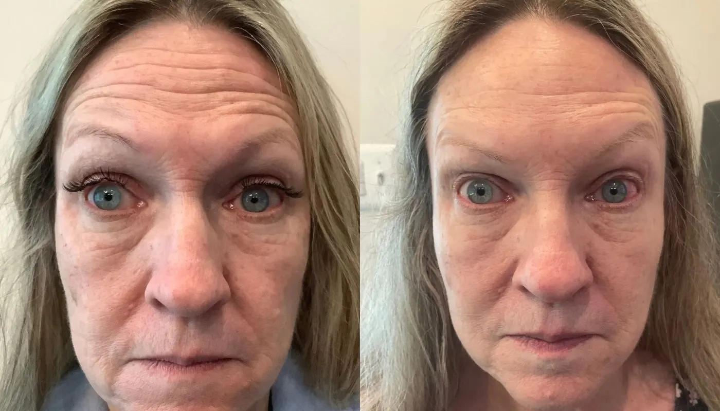 Daxxify — Before and After
