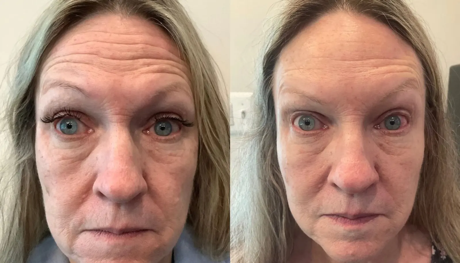 Daxxify — Before and After