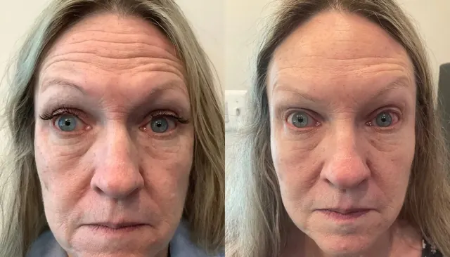 Daxxify before and after