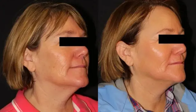 Microneedling before and after