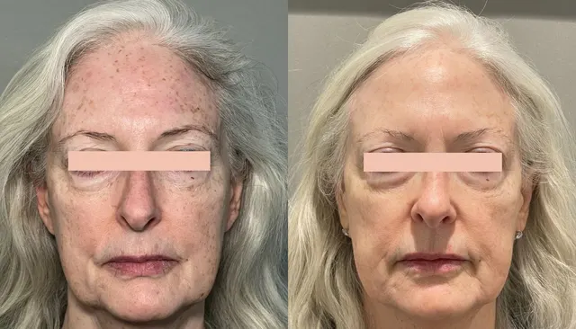 IPL Photo Rejuvenation before and after