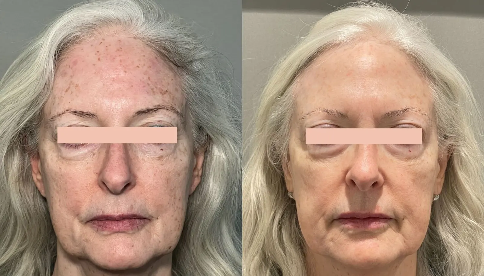Photo Rejuvenation — Before and After