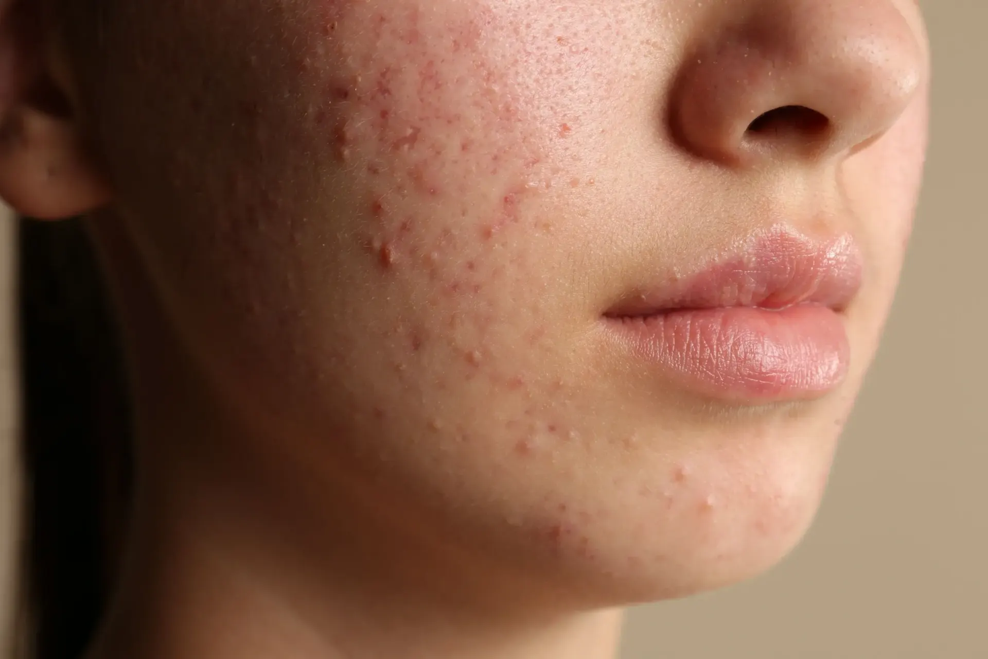 Woman with smooth refined skin after acne scar treatment at Pura Vida Med Spa in Fulton, MD