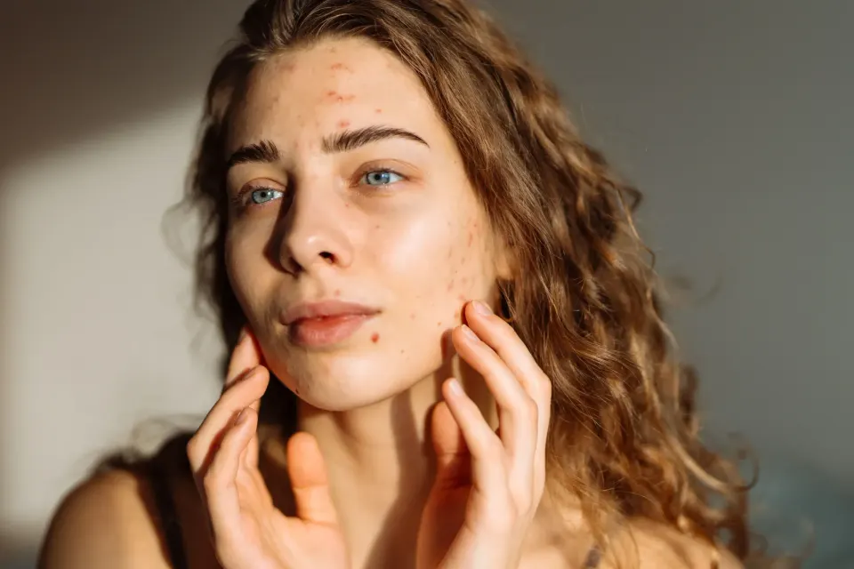 Visual comparison of ice pick, boxcar, rolling, and hypertrophic acne scar types