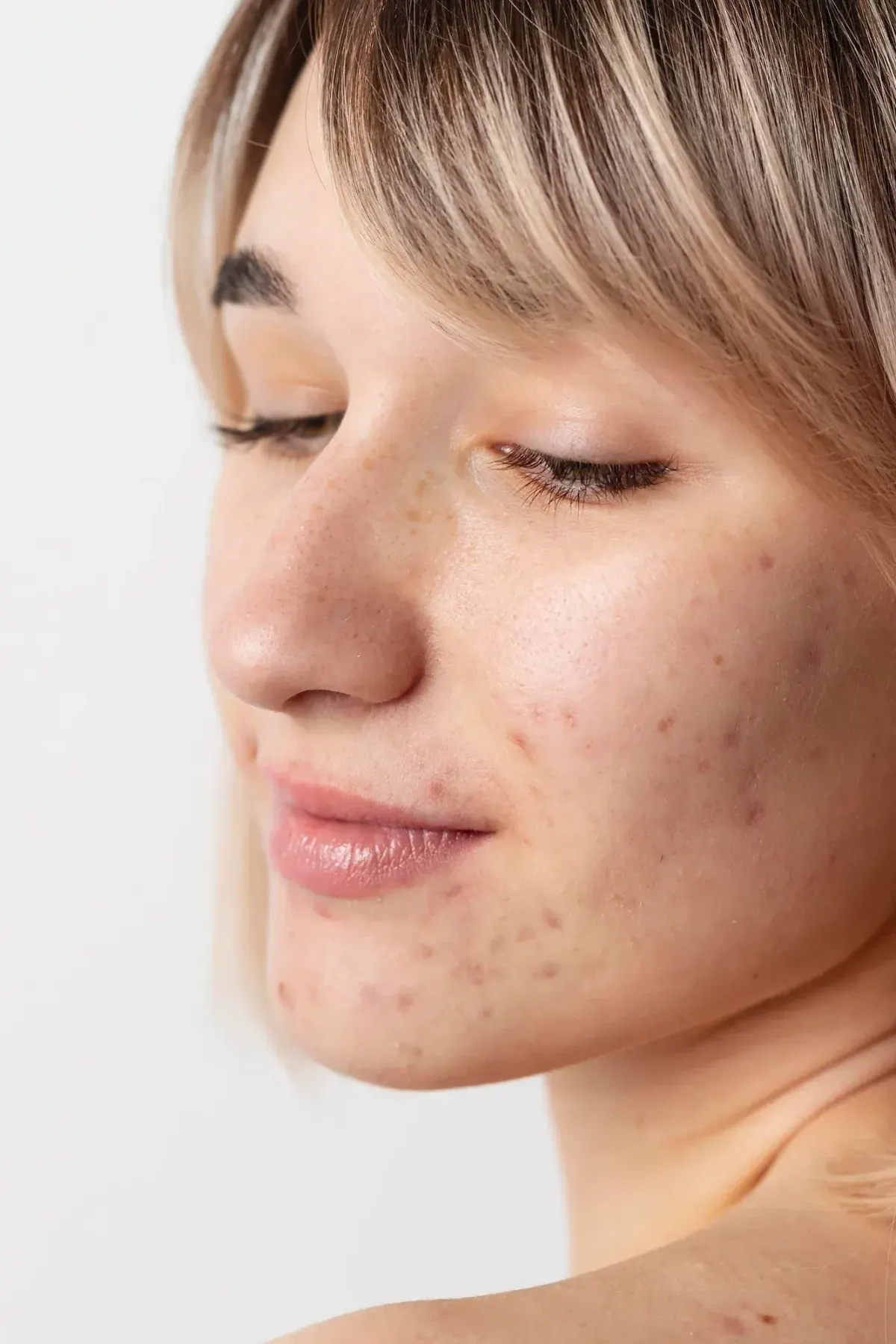 Close-up of patient skin showing acne scar texture before treatment at Pura Vida Med Spa