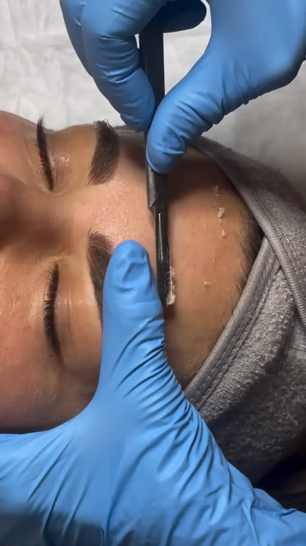 Gloved esthetician performing a dermaplaning treatment on a client's forehead