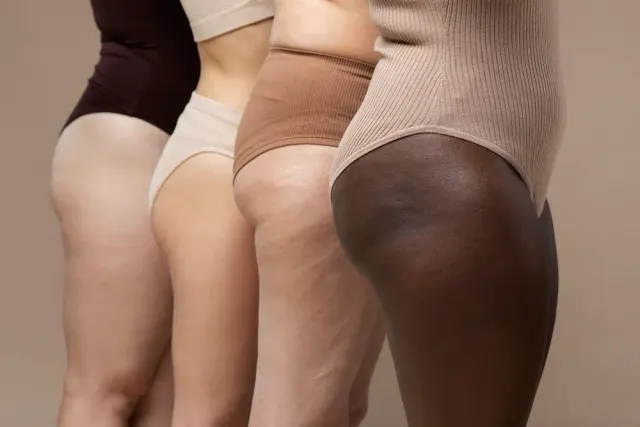 Lipedema vs Cellulite: How to Tell the Difference and When to Seek Treatment