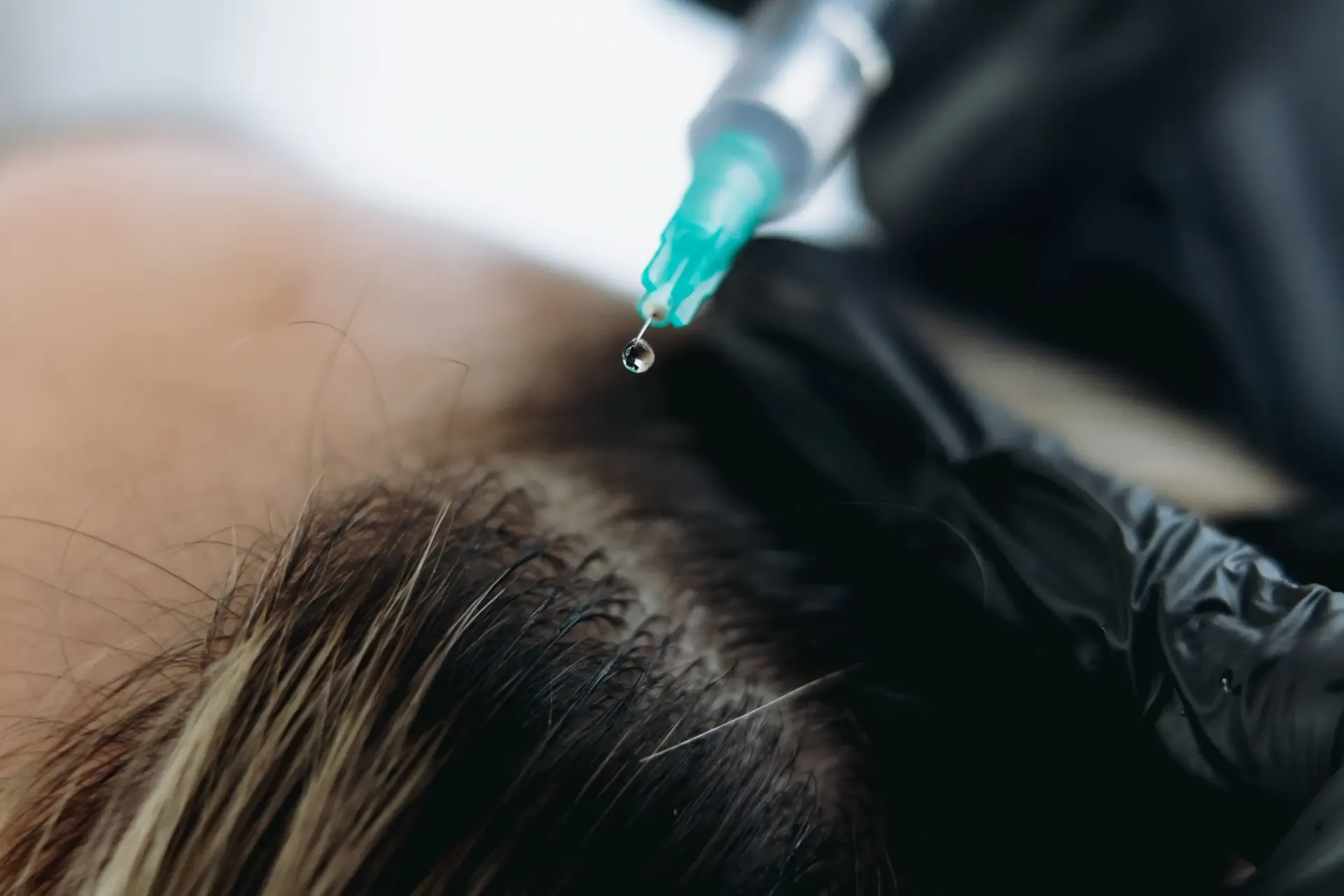 Patient receiving exosome hair therapy scalp treatment at Pura Vida Med Spa in Fulton, MD
