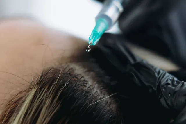 Patient receiving exosome hair therapy scalp treatment at Pura Vida Med Spa in Fulton, MD