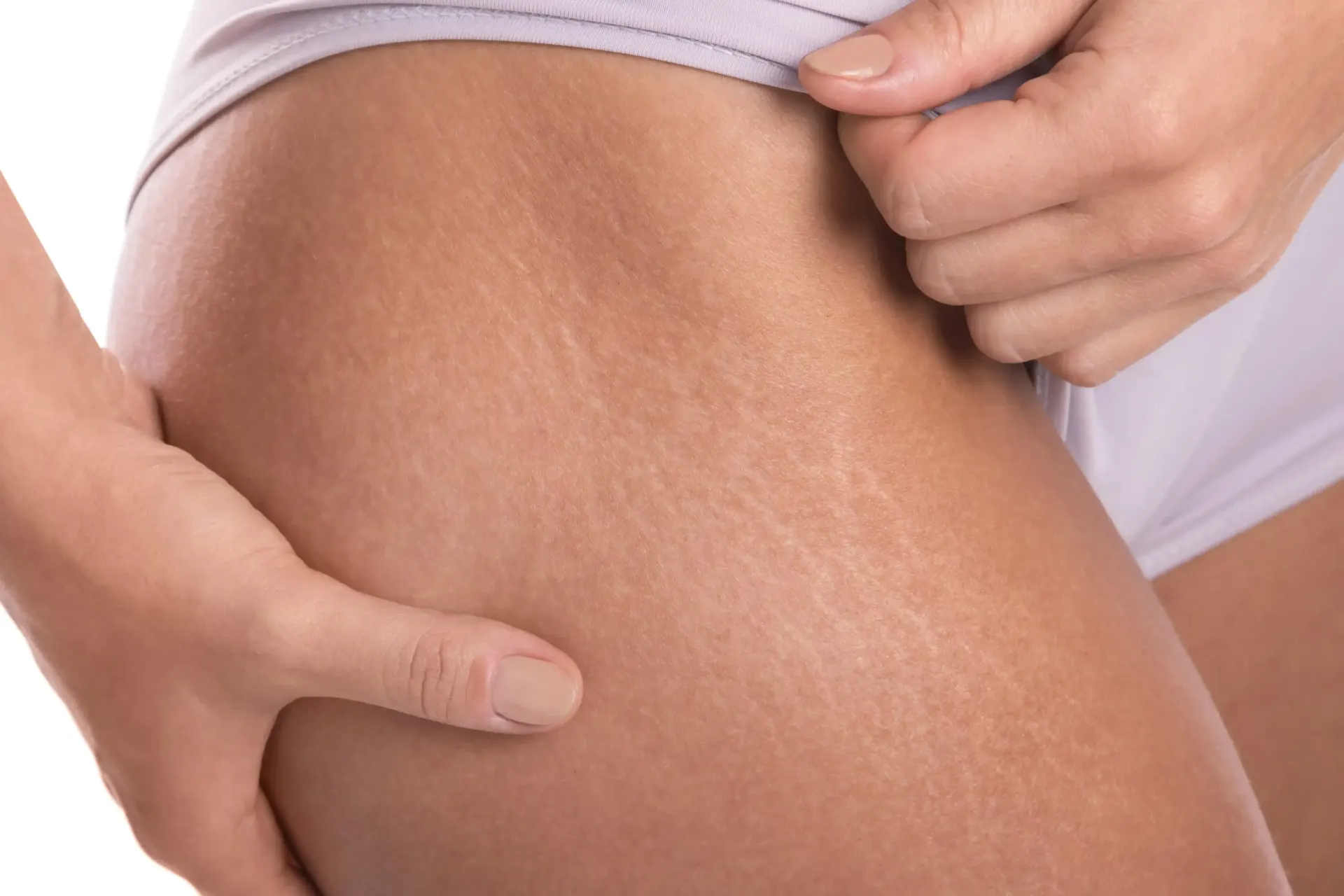 Close-up of woman's thigh and hip showing stretch marks on skin