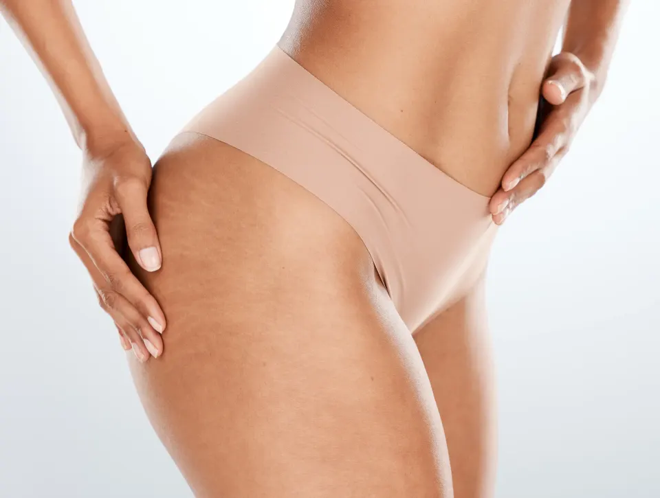Slim woman's midsection in underwear showing stretch marks on hip