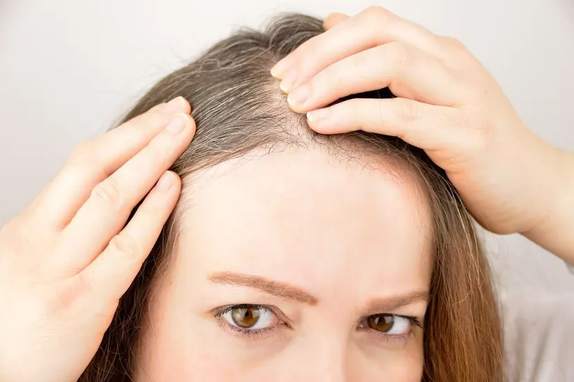 Woman parting her hair to reveal thinning at the scalp and hairline