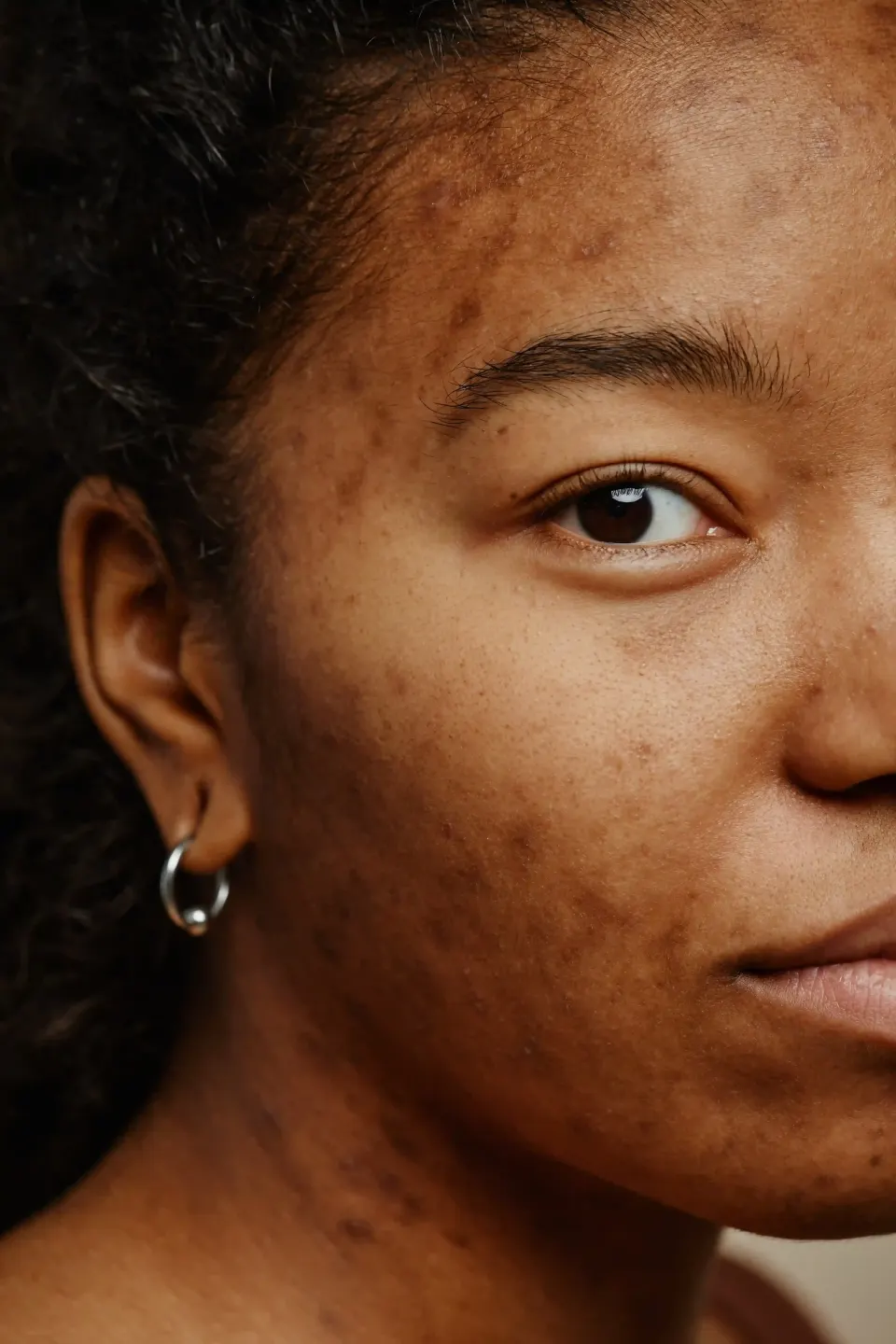 Half-face close-up of a woman with dark spots and hyperpigmentation on cheek