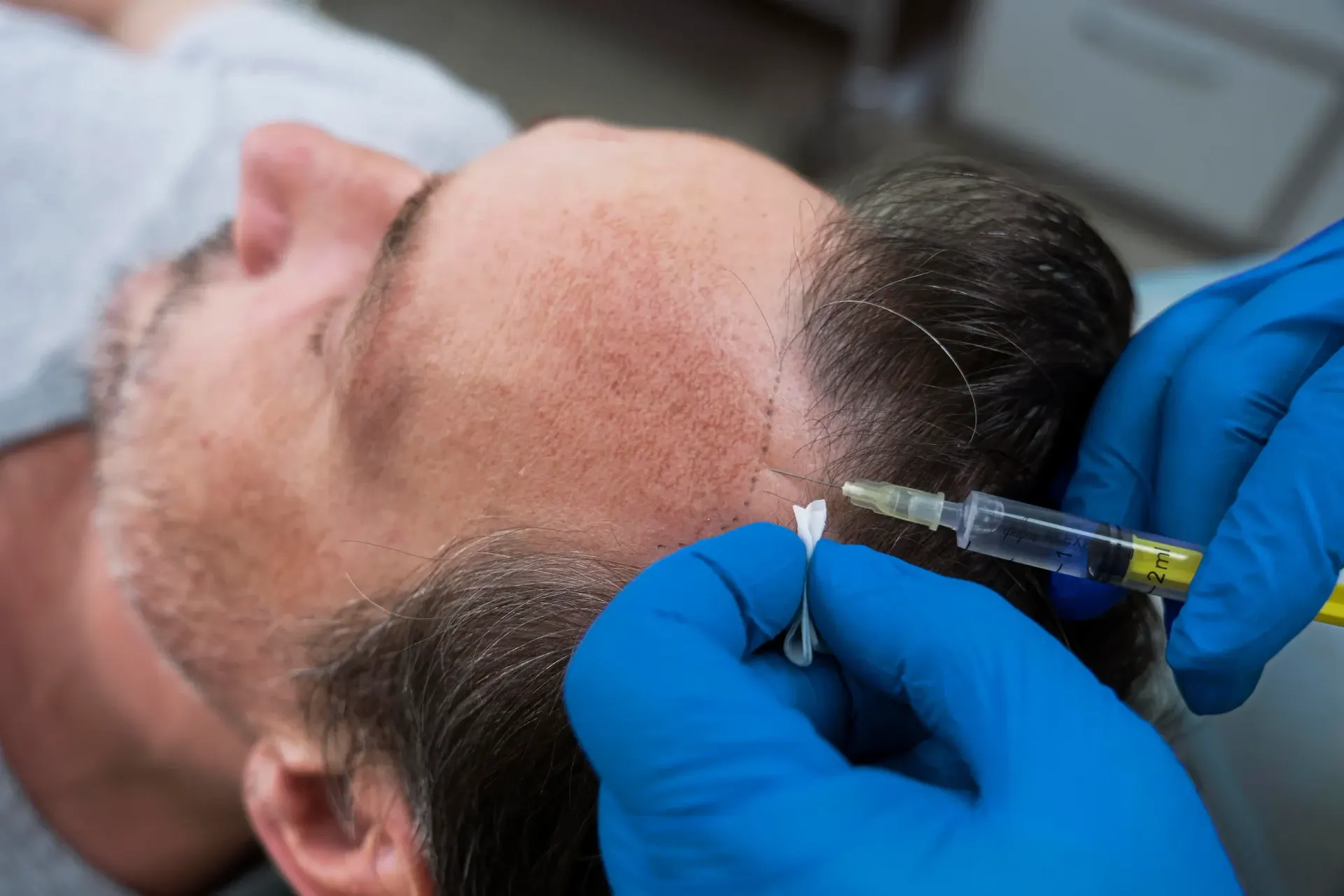 Woman with healthy thick hair after PRP hair treatment at Pura Vida Med Spa in Fulton, MD