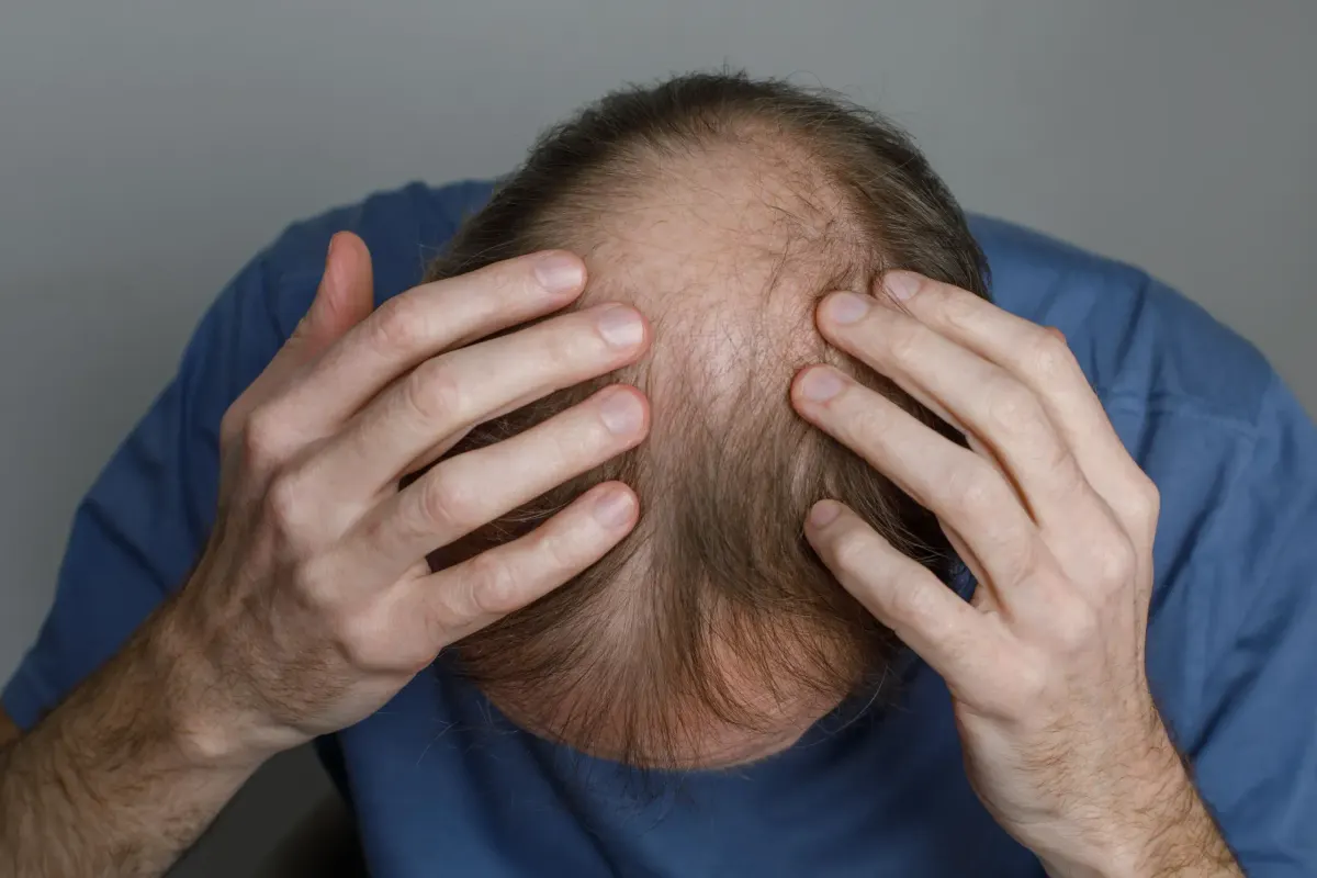 Man holding his head showing thinning hair and bald spot on crown