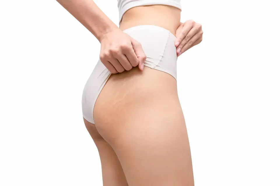 Woman's hip and thigh in underwear showing faint stretch marks