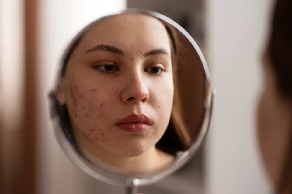 Cross-section diagram of acne scar formation in dermal collagen at Pura Vida Med Spa