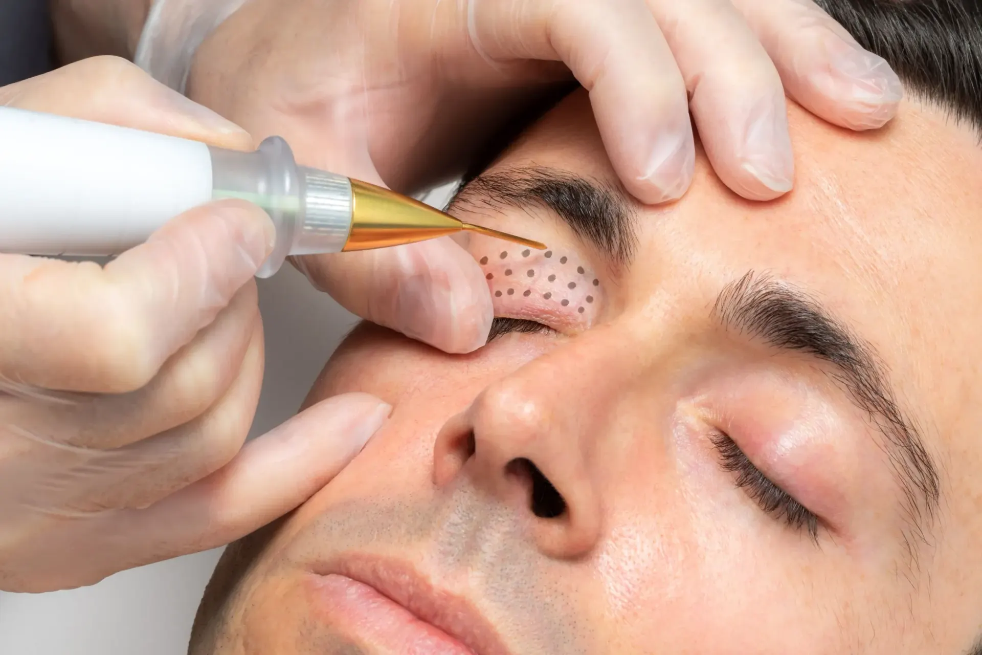Plasma pen fibroblast skin tightening treatment at Pura Vida Med Spa in Fulton, MD