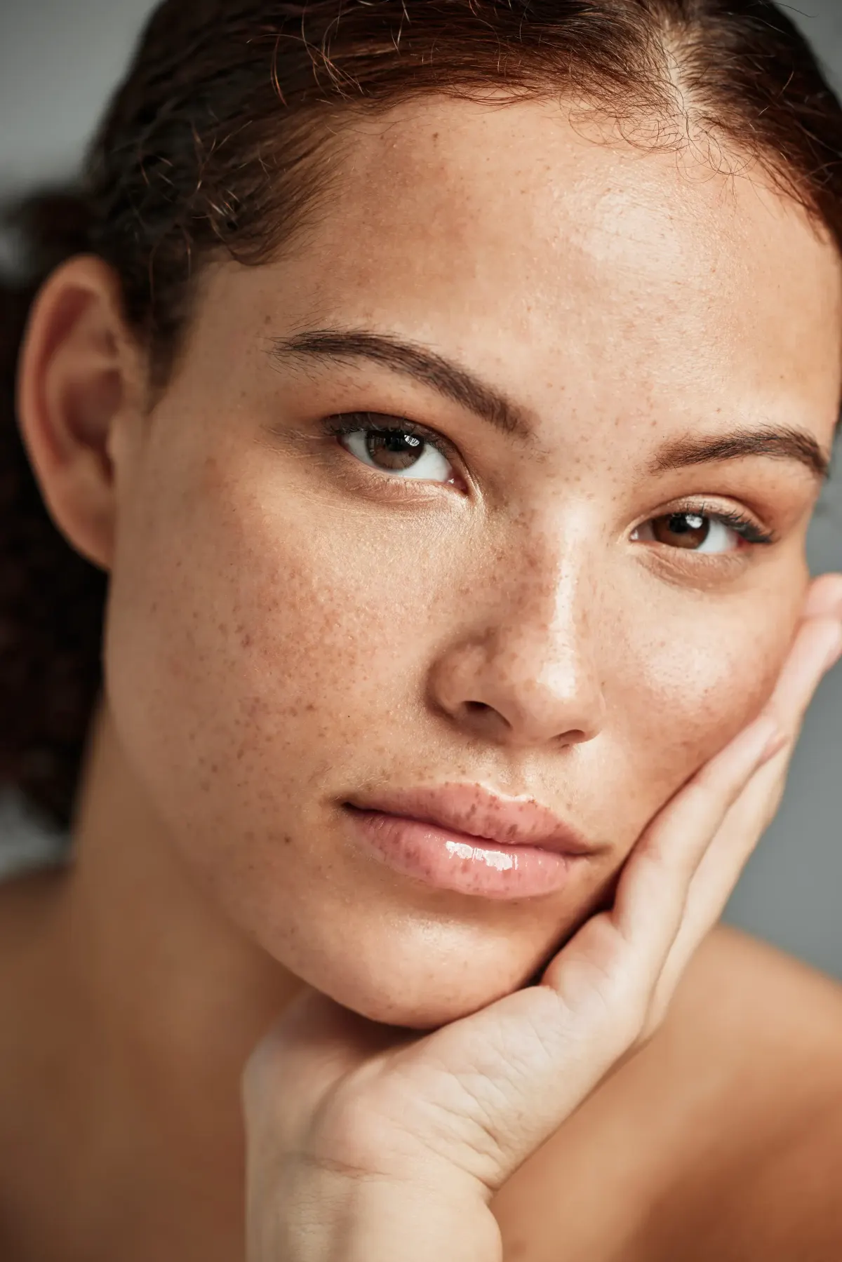 Close-up of young woman with freckled skin and dark spots resting on hand