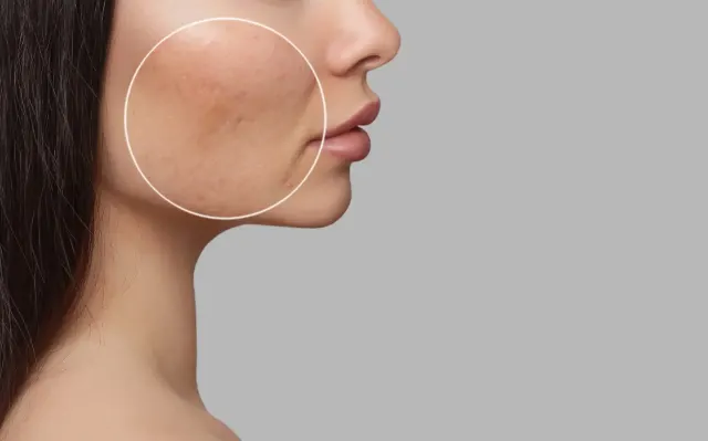 Are Acne Scars Permanent? Non-Invasive Treatments To Get Rid Of Them Fast