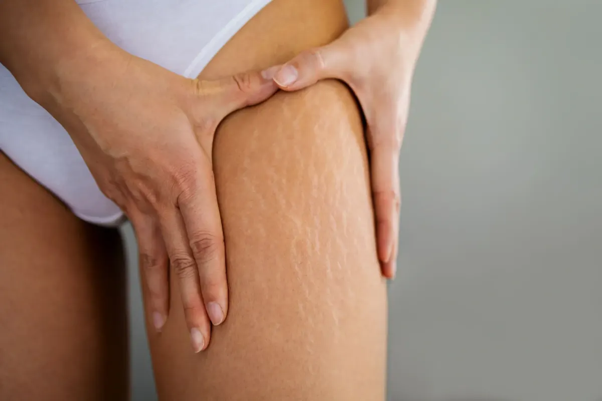 Close-up of woman's thigh showing white stretch marks, hands touching skin