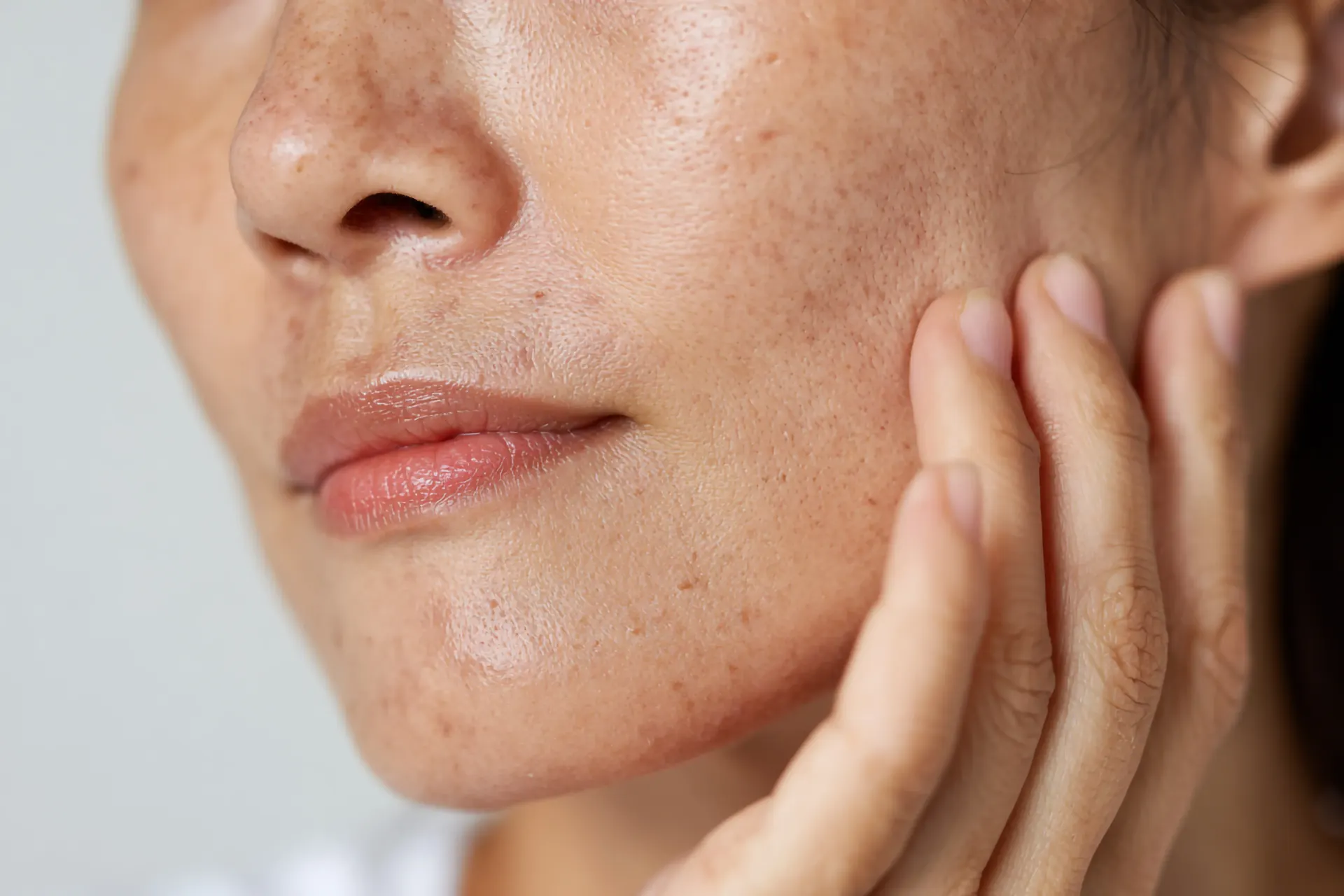 Close-up of a woman touching her cheek, showing facial hyperpigmentation and dark spots
